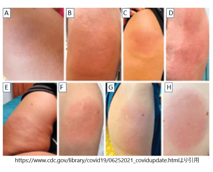 mRNA-1273ワクチン1回目投与後の遅発性大局所反応